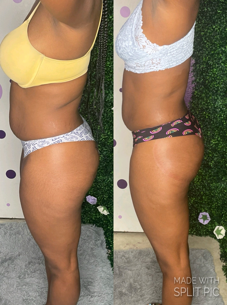 Skin Tightening 60mins
