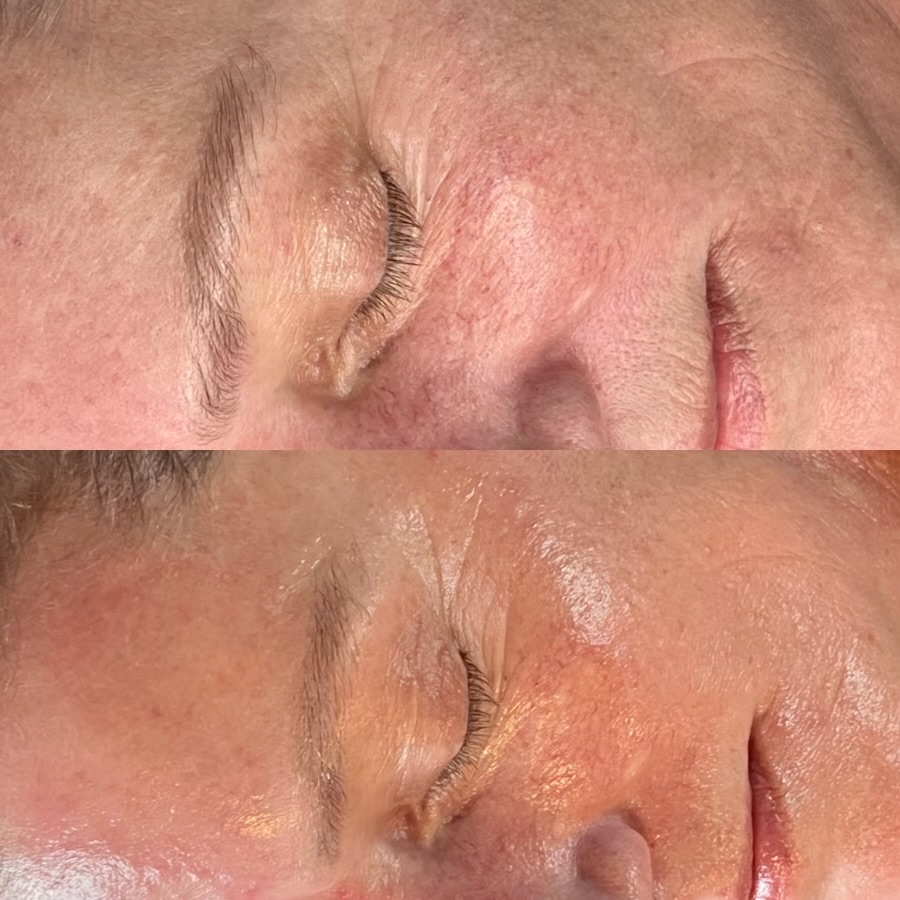 Microneedling (Per Area)