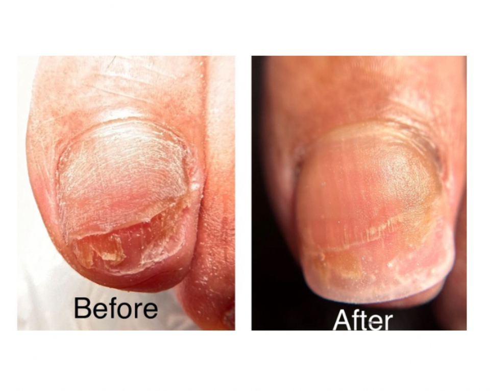 Toenail Restoration