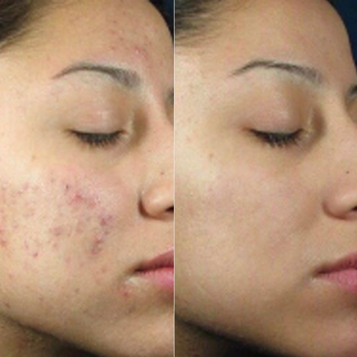 Teen Acne Treatment at Genie of Skin in Mooresville, NC