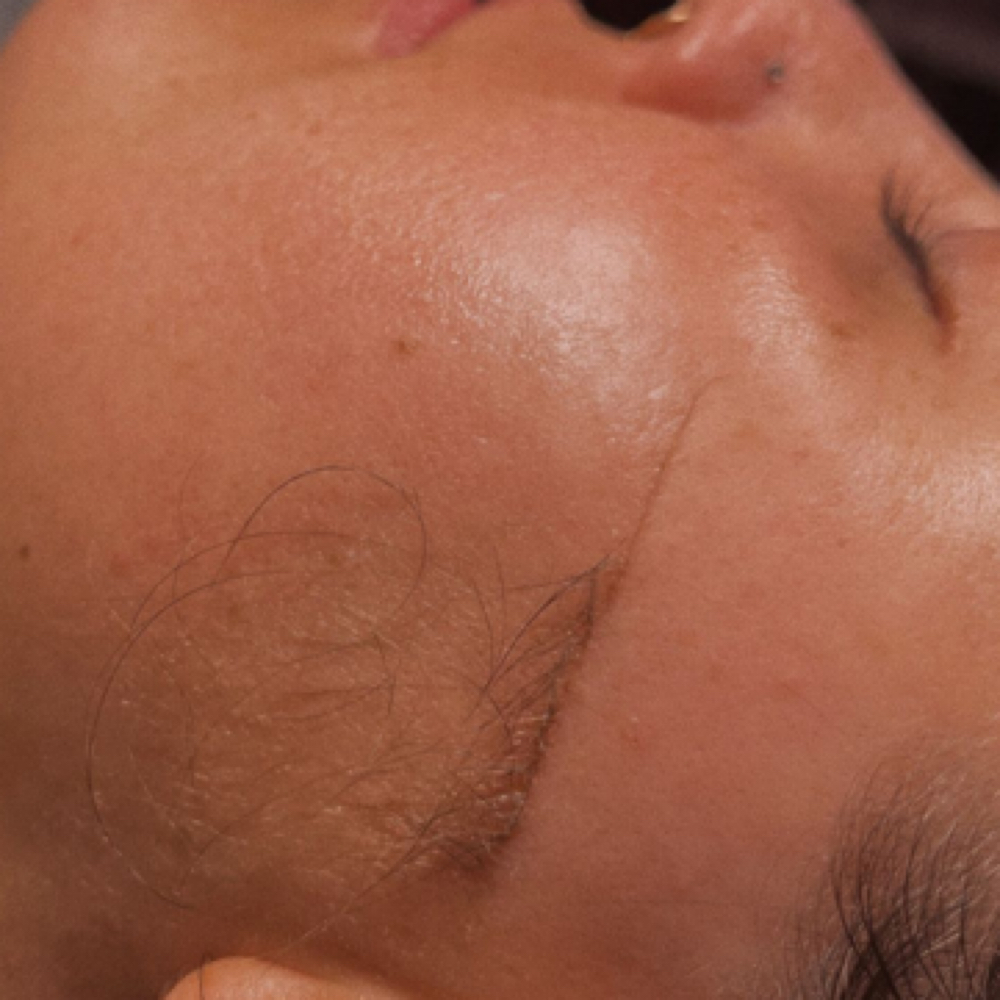 Dermaplane Facial at Simple Skin With Madison in Omaha, NE