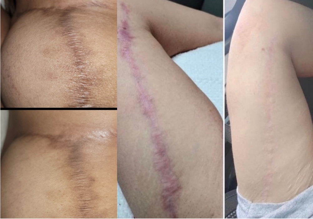 Scar Restoration Microneedling at Sarah Stone Cosmetic Tattoo Clinic in Fontana, CA