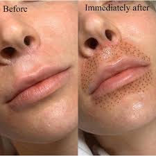 Lip Plasma Fibroblast