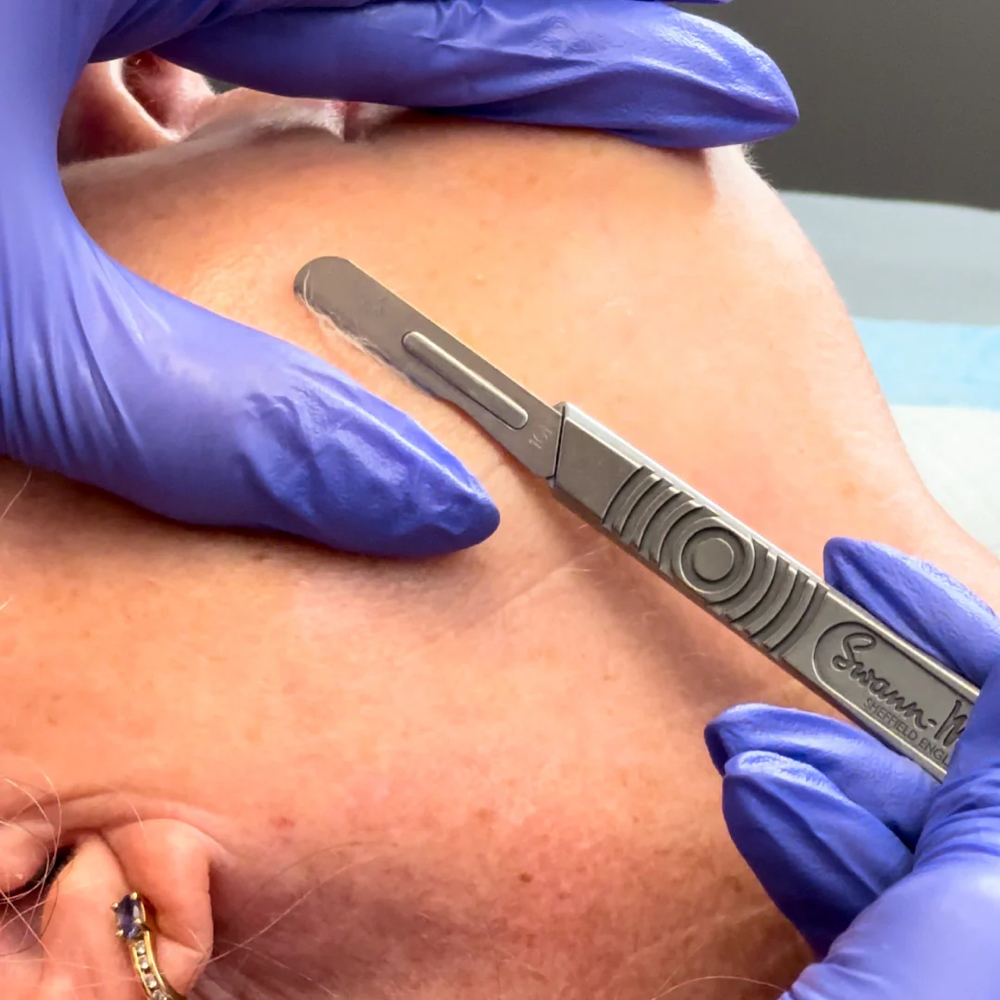 Dermaplane Add On