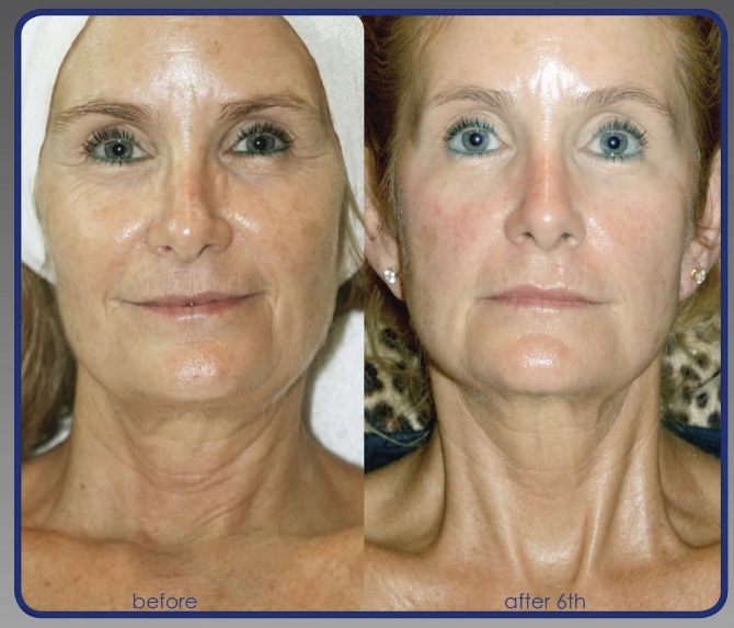 SWICH Rejuvenating Facial
