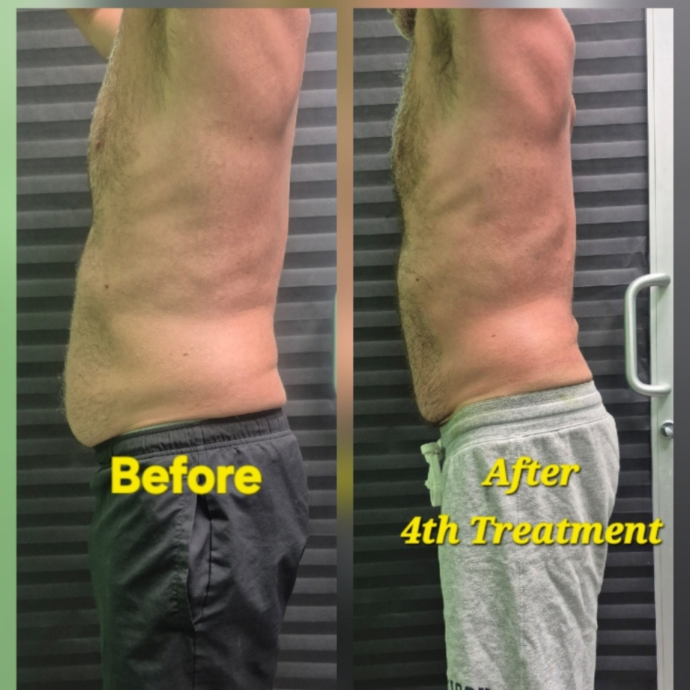 Stomach Reduction Treatment at JUST BEAUTIFUL SKIN in Goose Creek, SC