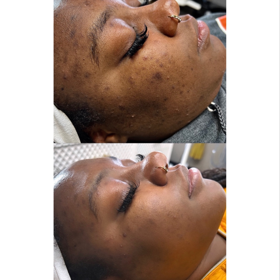 PEEL LEVEL 2 (Medium Depth Peel) at FIRMÉ SKIN in Columbia, MD