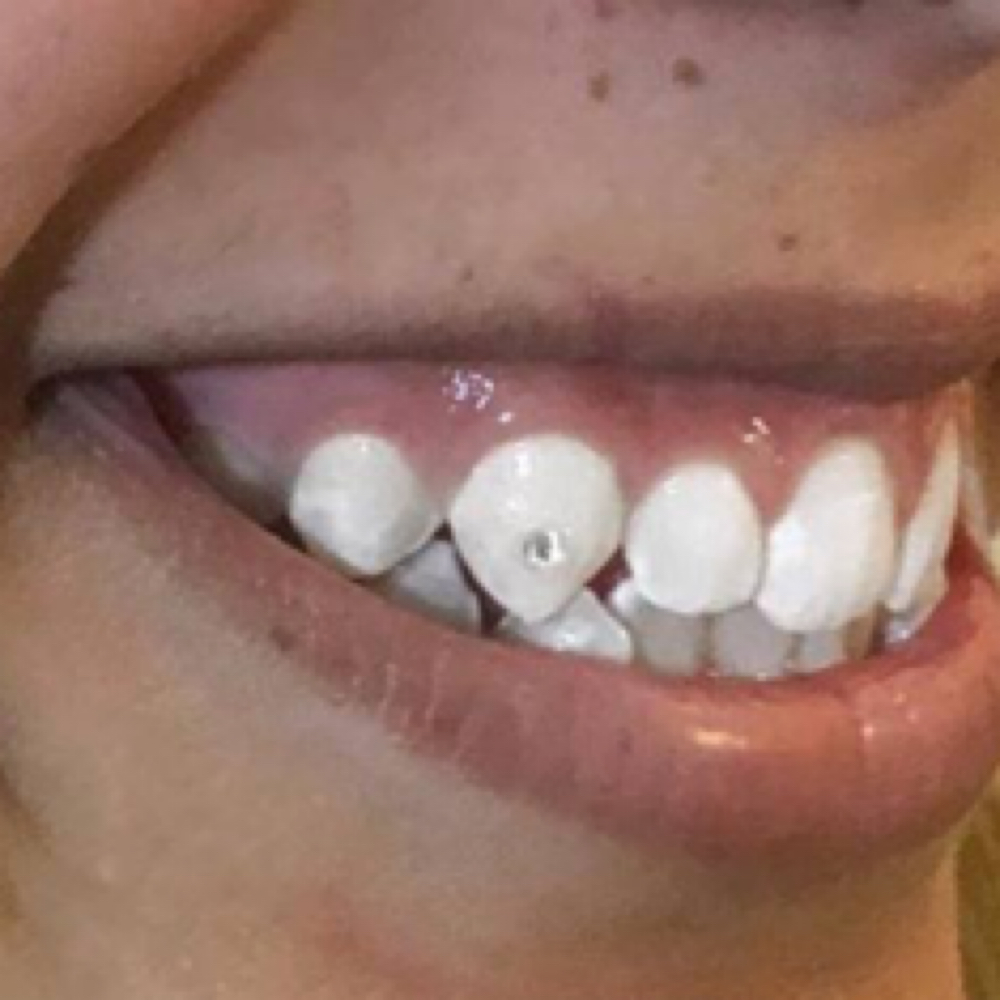 90 Min Teeth Whitening Session at iGlow Skin Solutions LLC in Eatontown, NJ