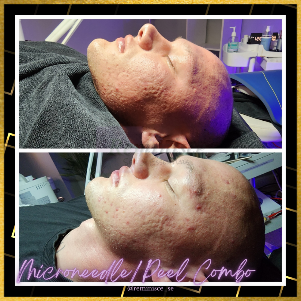 Microneedling + Peel Combination