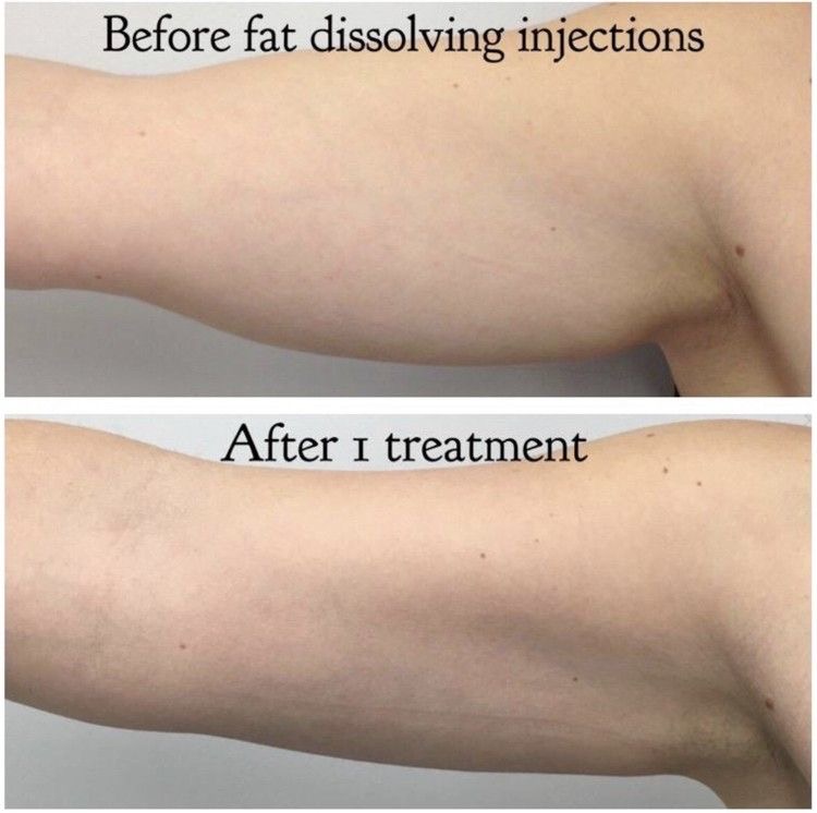 Lipo-Dissolve: Medium Area Session