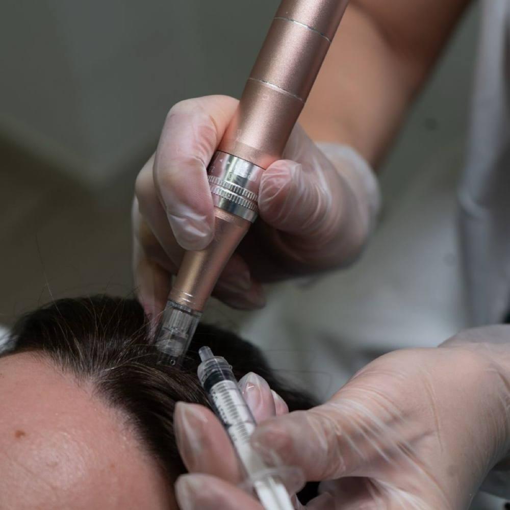 Hair Growth Mesotherapy Treatment at GLOWBAR Aesthetics & Beauty Co. in Palm Coast, FL