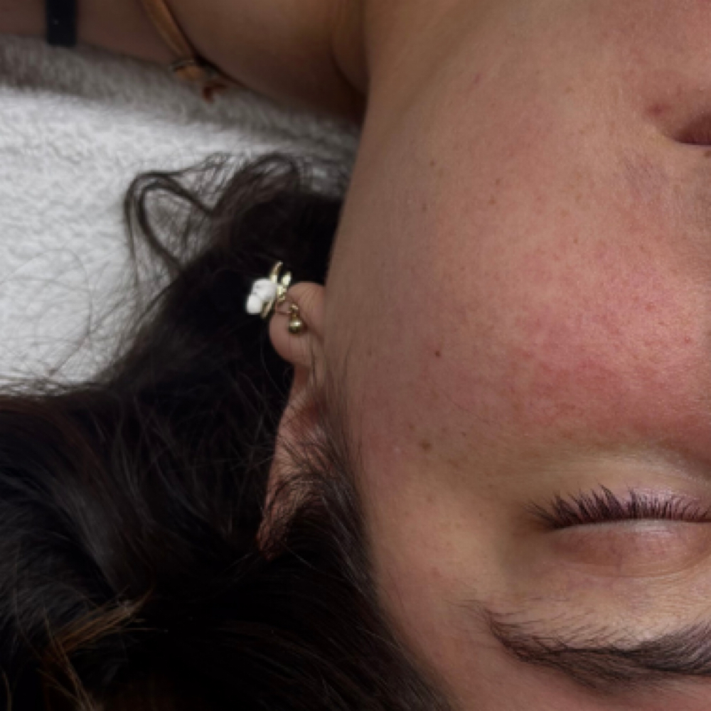 Chemical Peel at Honey Whim Esthetics in Salt Lake City, UT