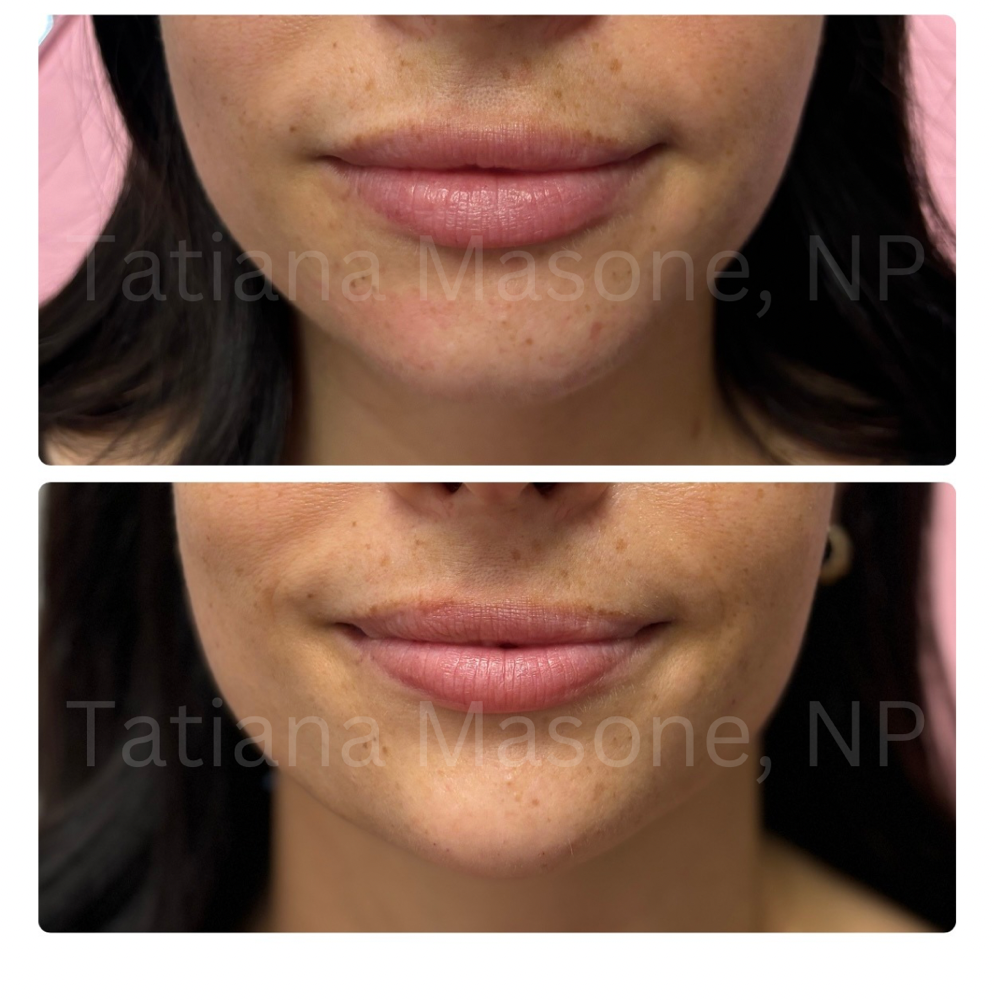 Chin Filler