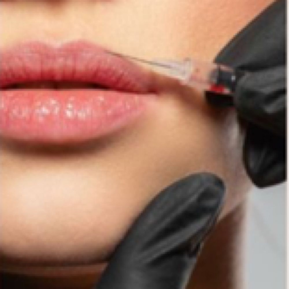 Lip Filler Full Syringe at Aesthetics by Emmie in Charleston, WV