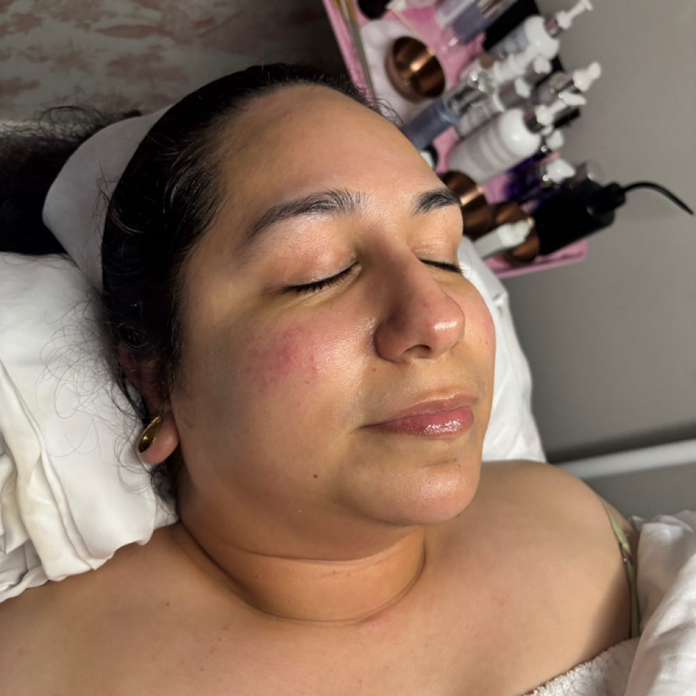 Microdermbrasion Facial at Zelle Aesthetics in Bedford, TX