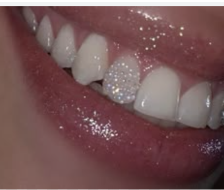 Chandelier (one tooth)
