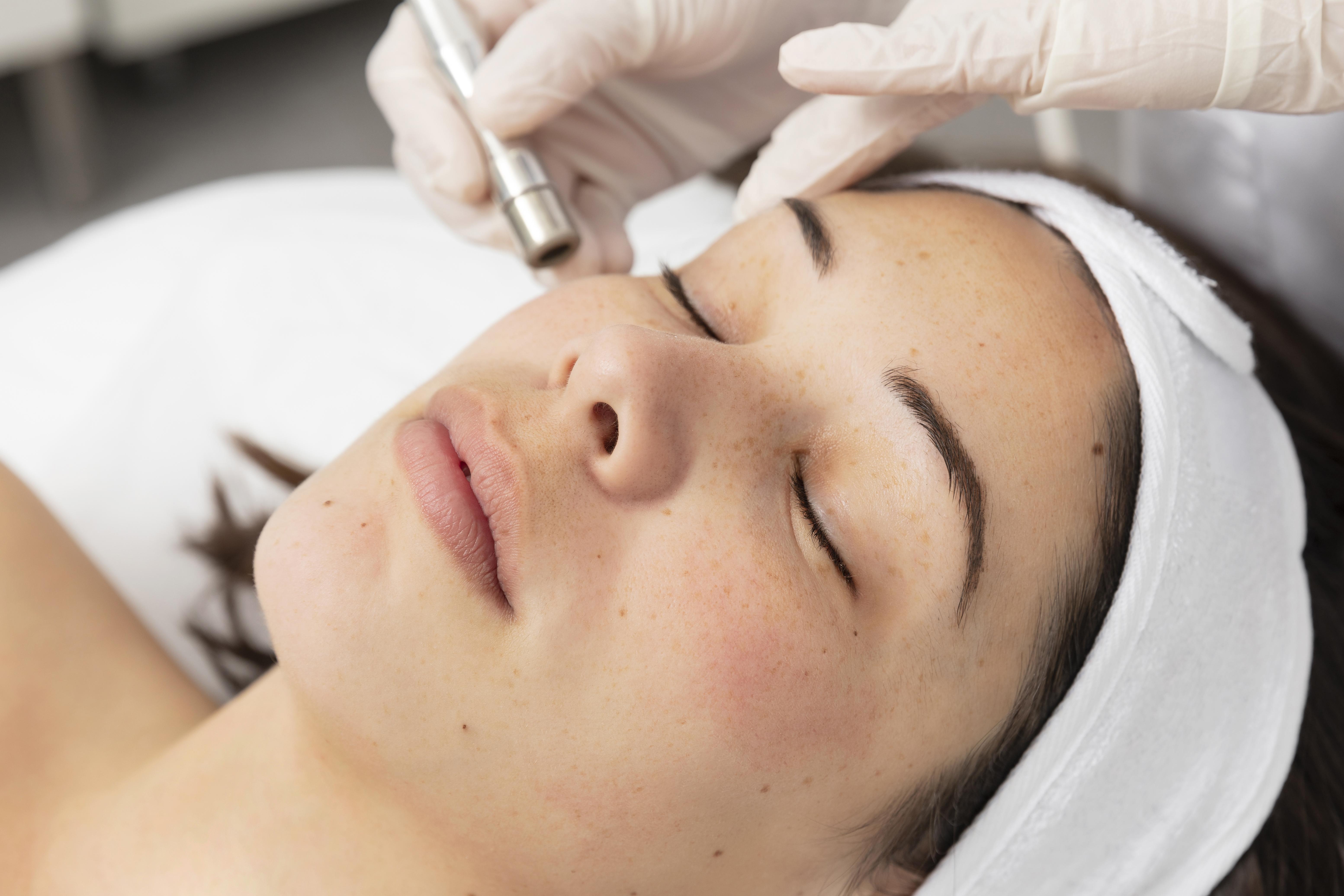 Microdermabrasion Treatment