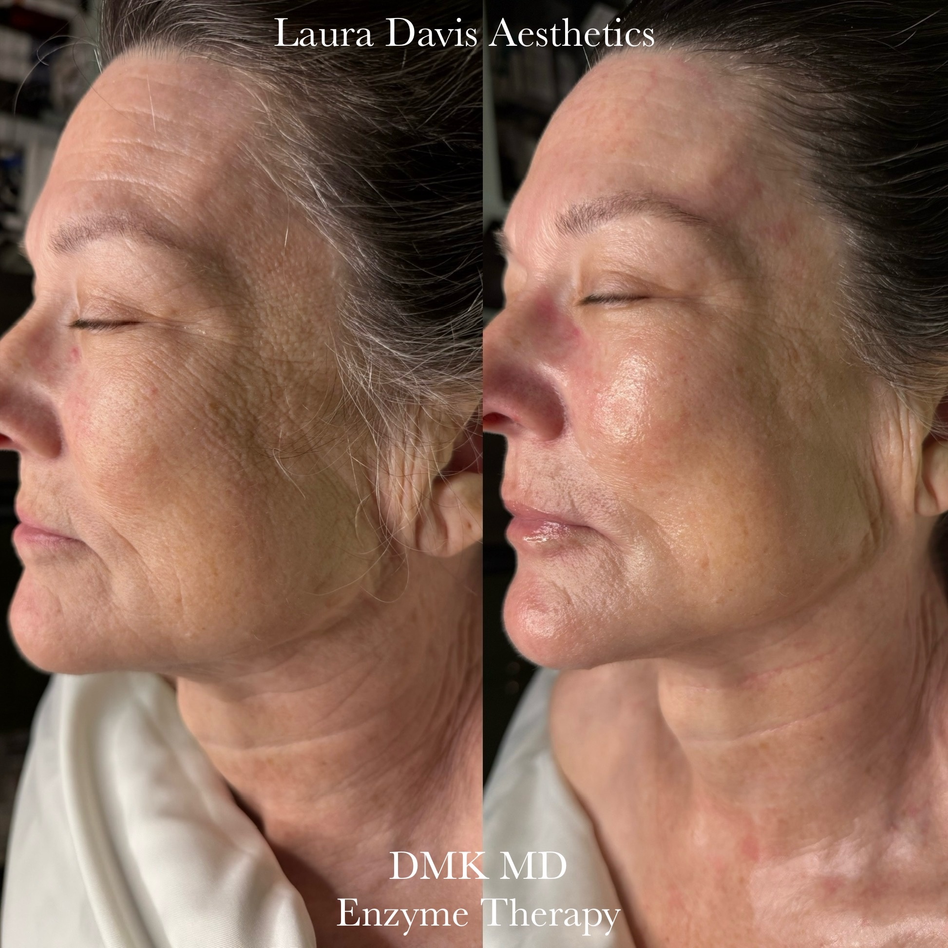 Advanced DMK Enzyme Therapy at Laura Davis Aesthetics in Buda, TX