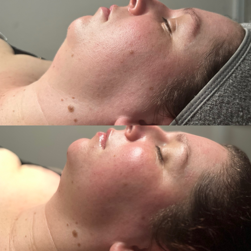 Skin Sculpting Facial