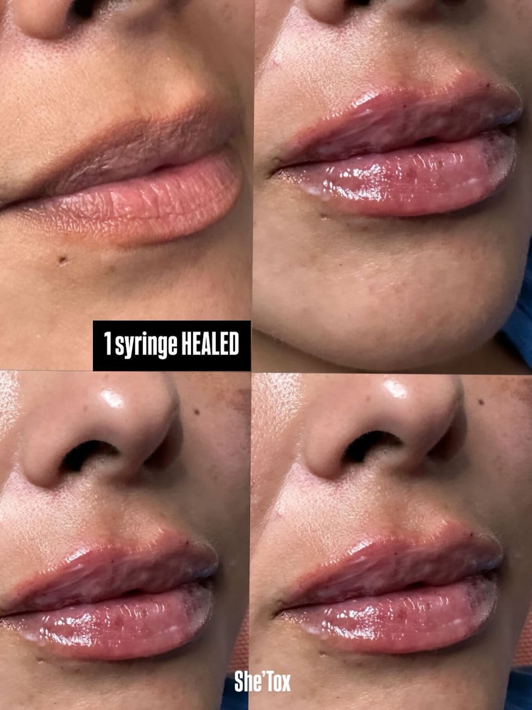 Lip Filler 💉