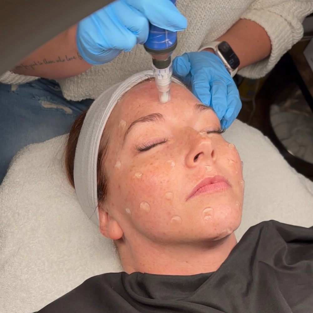 Microneedling(Face) at Haley Copeland Esthetics in Knoxville, TN