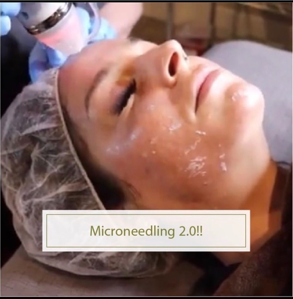 Microneedling + Radio Frequency