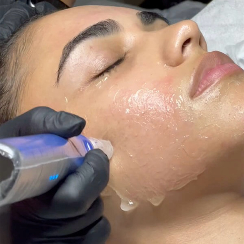 SkinPen Microneedling at Liv For Aesthetics in Tempe, AZ