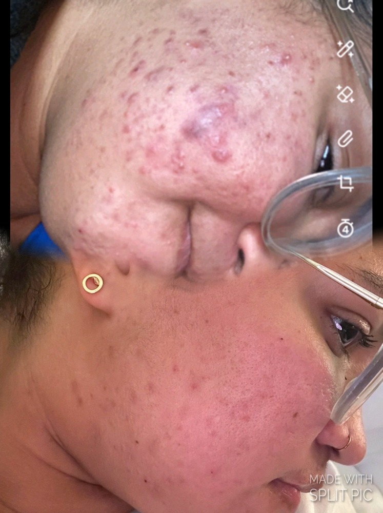 Chemical Peel Facial Glow at Adarable Esthetics LLC in Taunton, MA