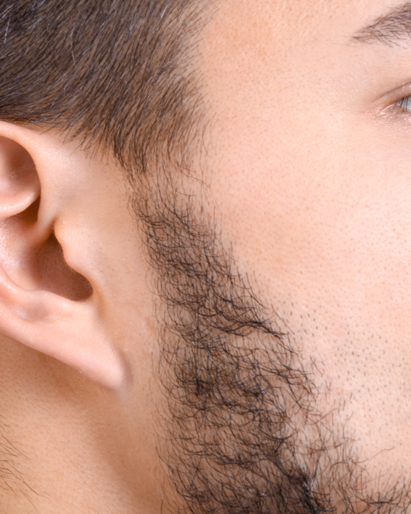 Sideburns Only Laser Hair Removal at M.A.V Aesthetics in Fort Morgan, CO