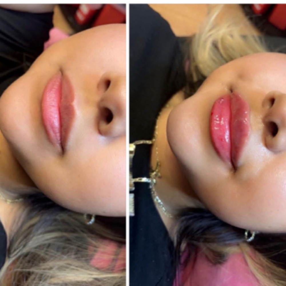Lip Fillers(full) at Abigail Espinoza in Angleton, TX