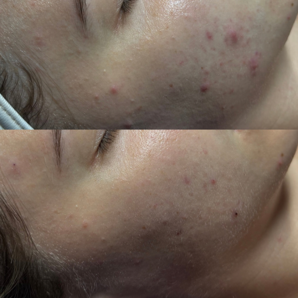 Virtual Acne Bootcamp at Satin Skin Esthetics LLC in Glens Falls, NY