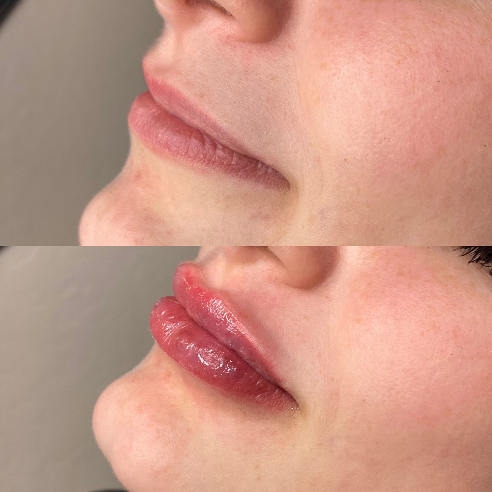 1.5ML HA Lip Filler