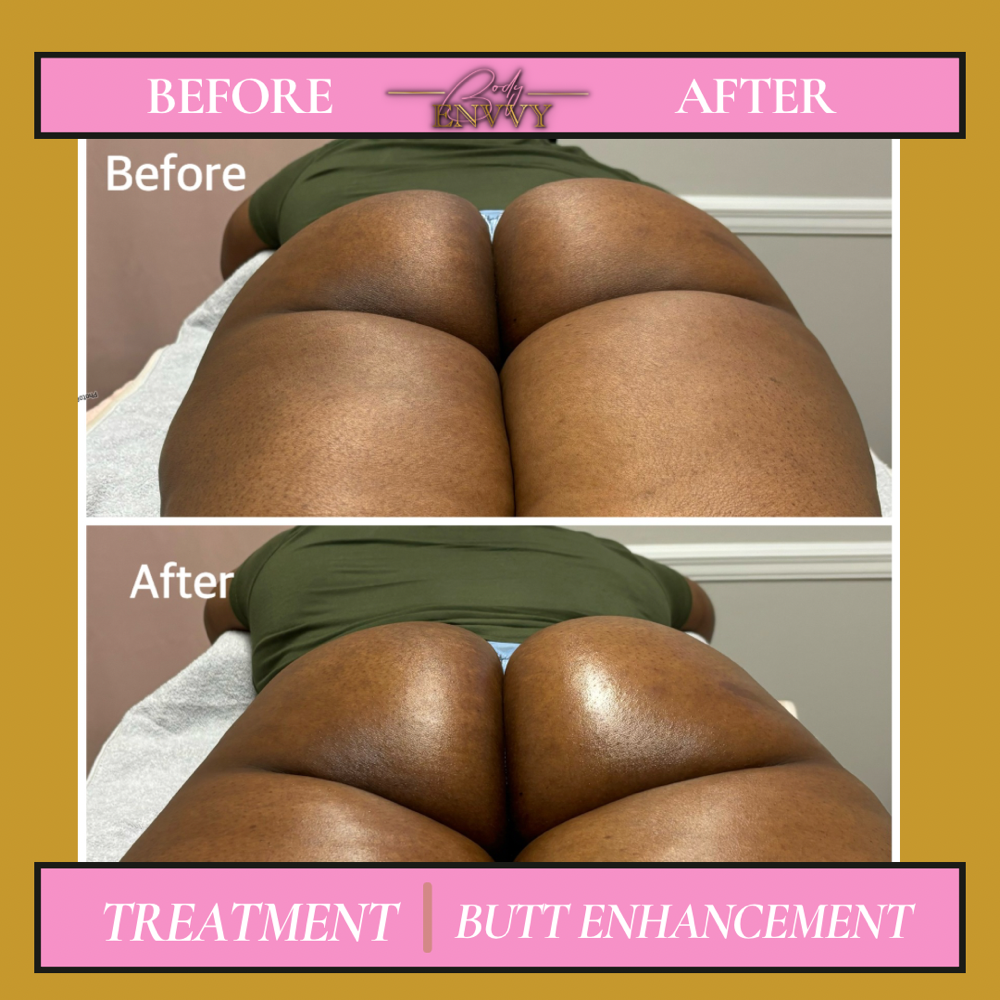 Butt Enhancement