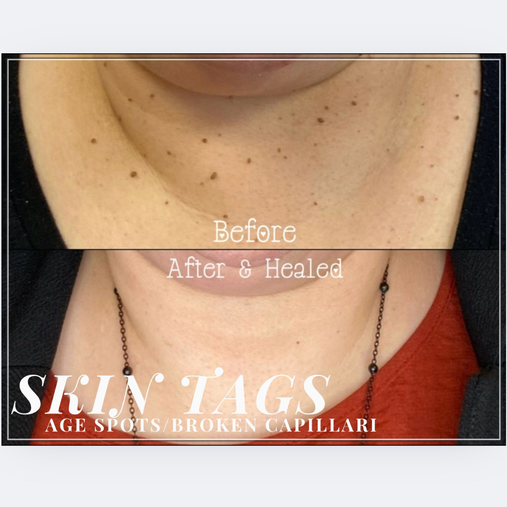 SkinTags/Age Spots/Broken Capillari