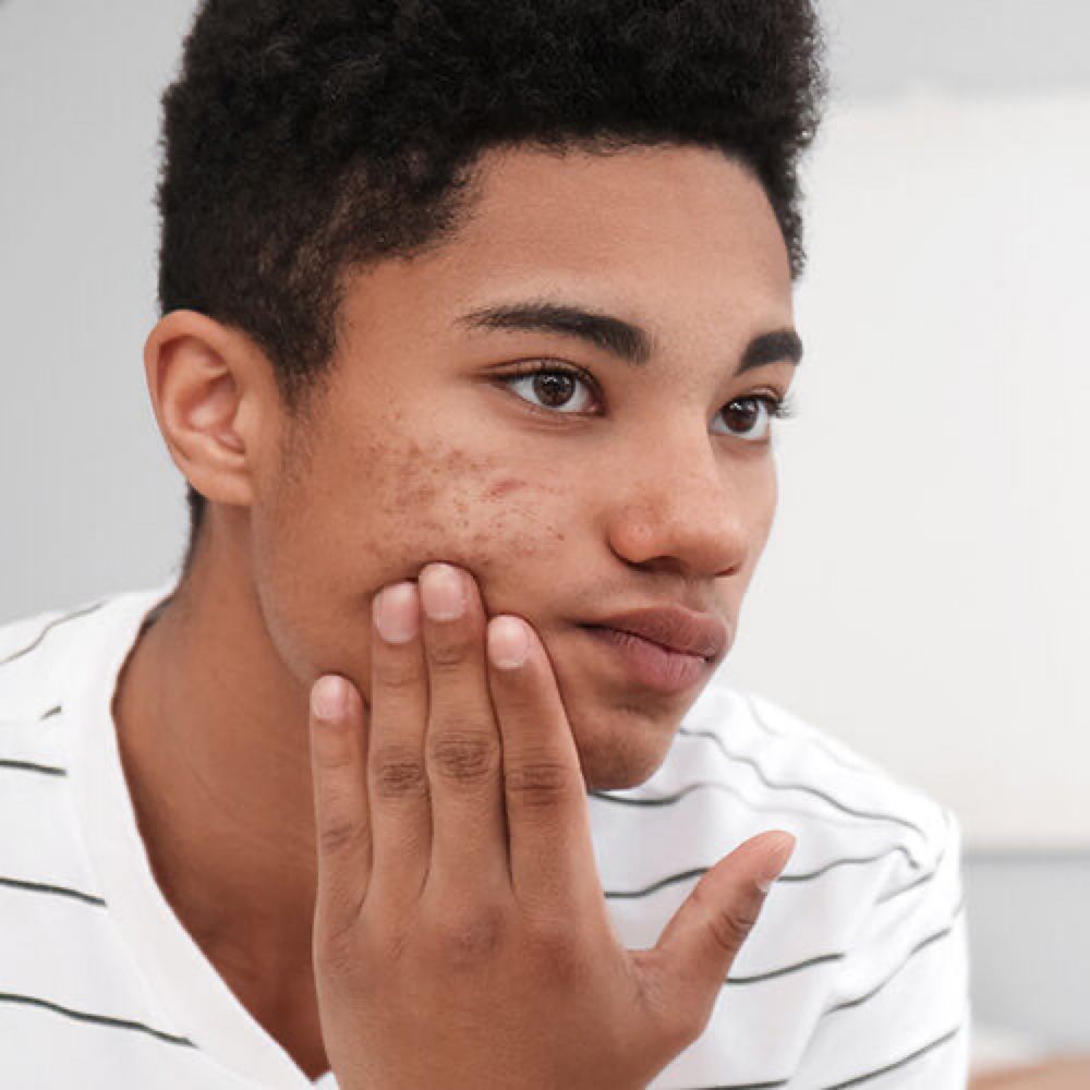 Teen Acne Facial at Radiant Glow Skin Spa in Beaumont, TX
