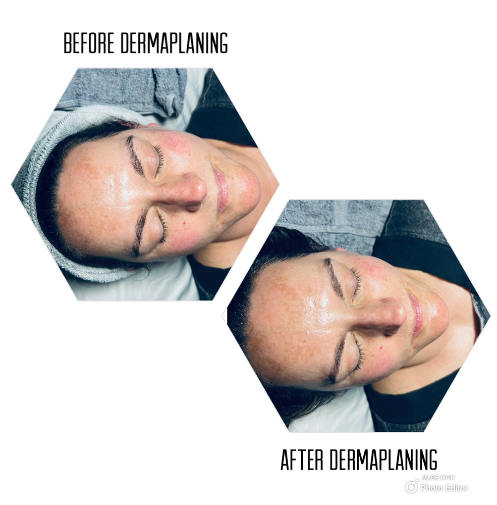 Add on Dermaplaning