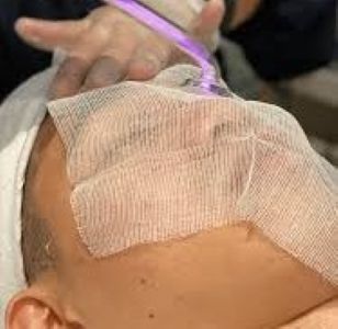 Acne Facial