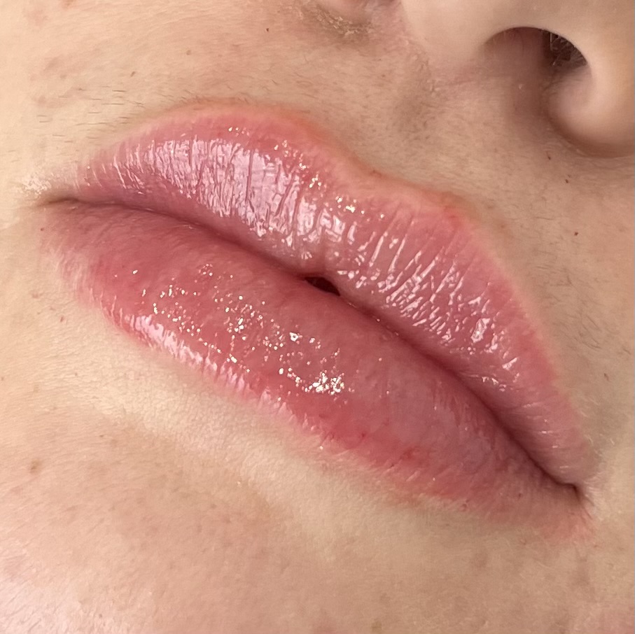 Mini Lip Plump- 1/2 syringe at The Inked Aesthetic Nurse in Coeur D Alene, ID