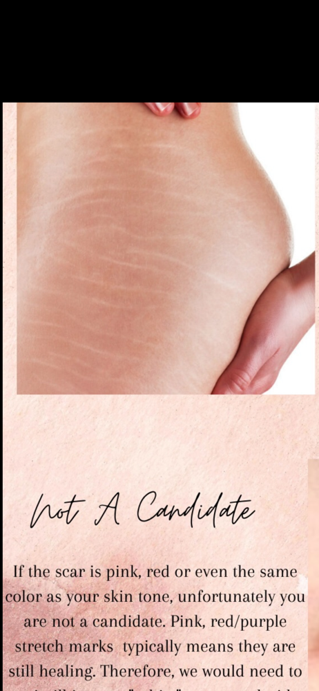 Model For Stretch Mark Tattoo