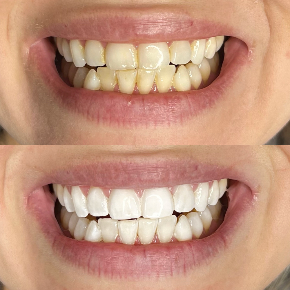 LED Laser Teeth Whitening