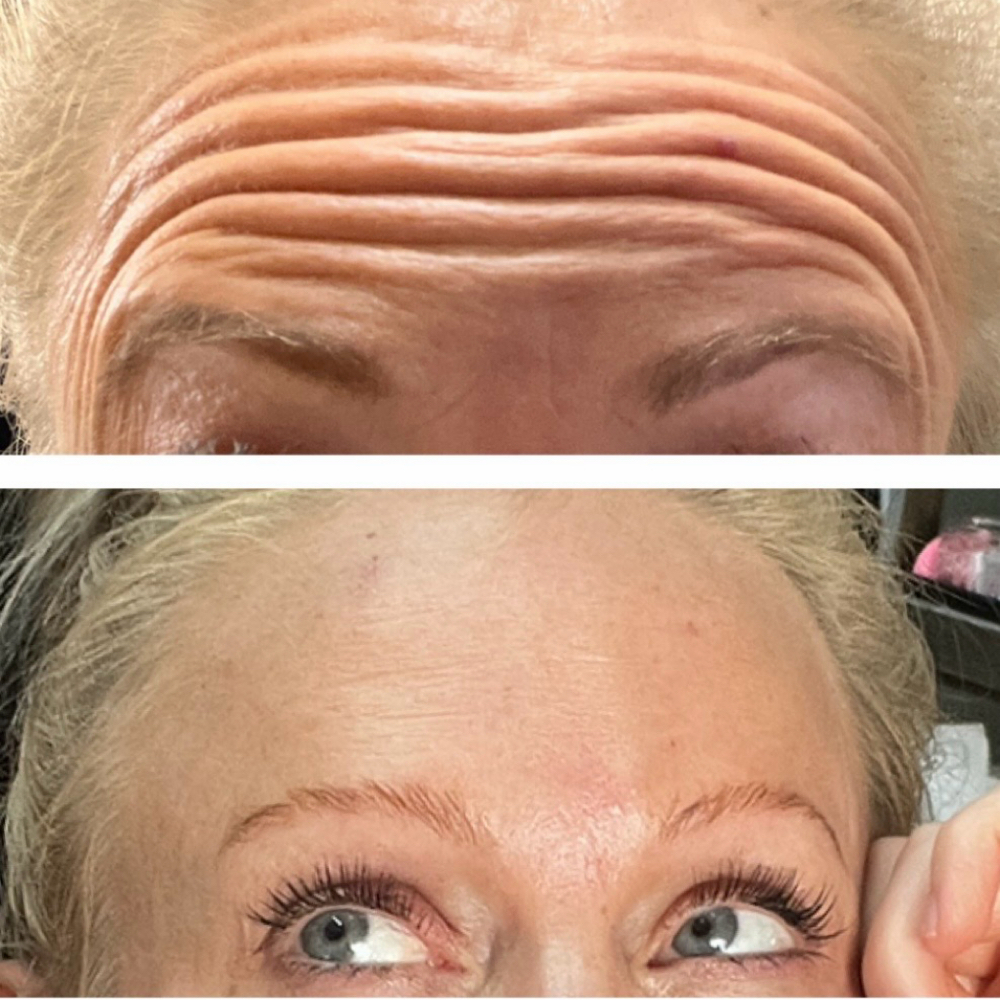 Tox (Daxxify, Jeuveau, Botox) at Southern Sparkle Medical Aesthetics in Swainsboro, GA