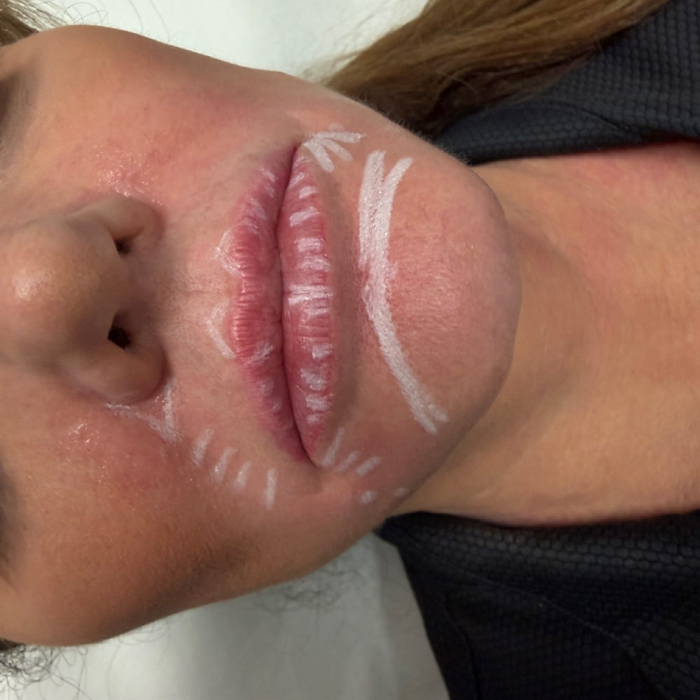 Lip And Chin refresh at Atelier Aesthetics and Infusions in Dallas, TX
