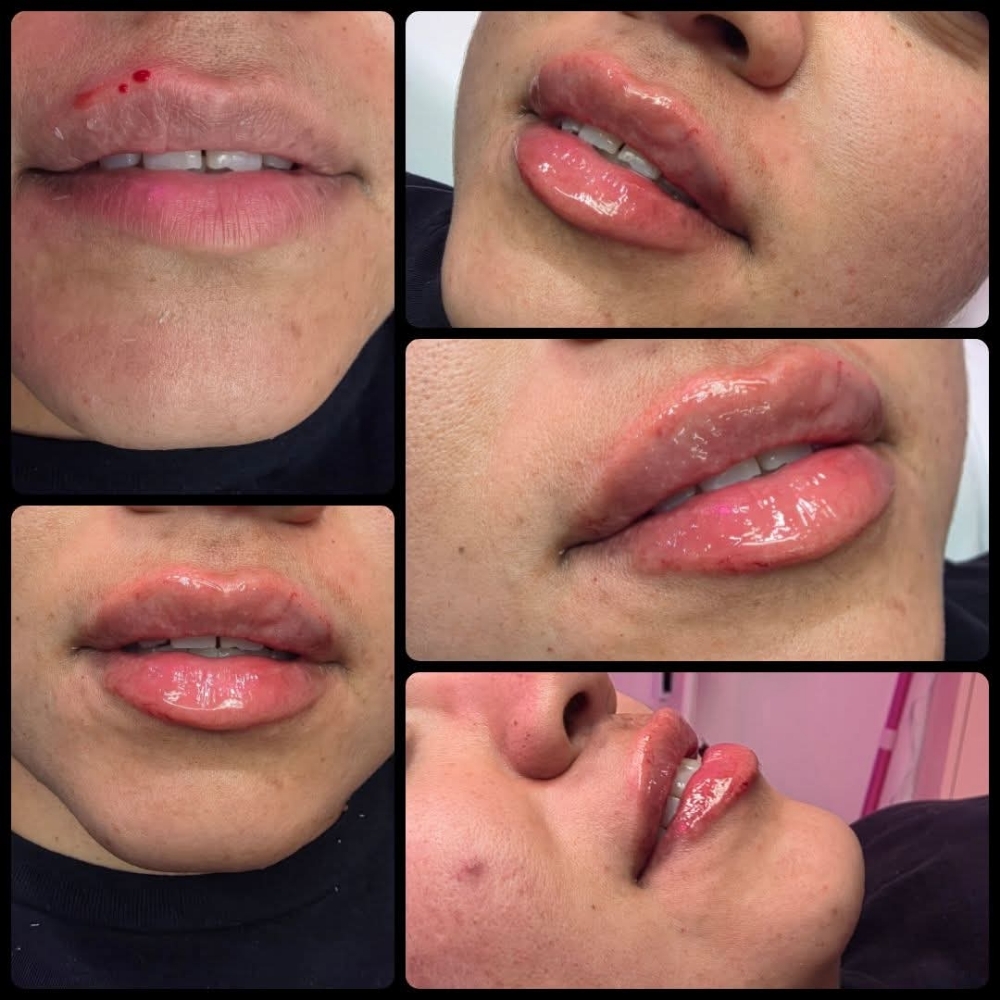 Filler Services at Glass Face Aesthetics LLC in Fort Stockton, TX