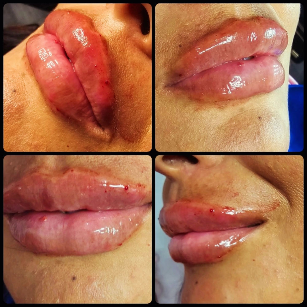 Lip Filler Full Syringe