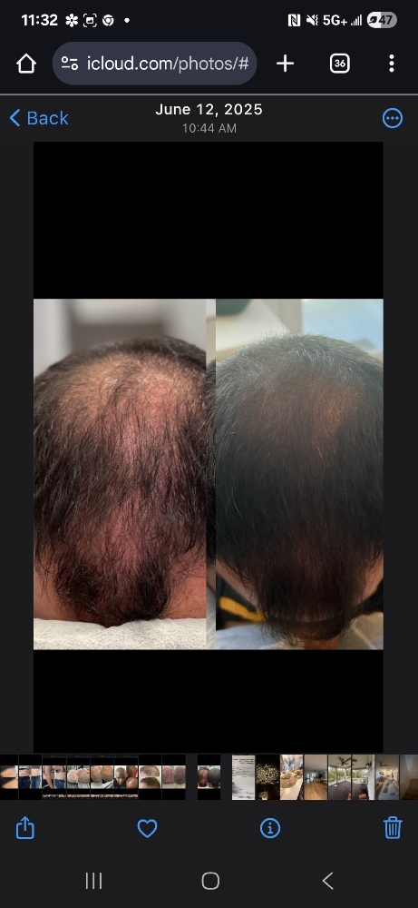 Hair Restoration
