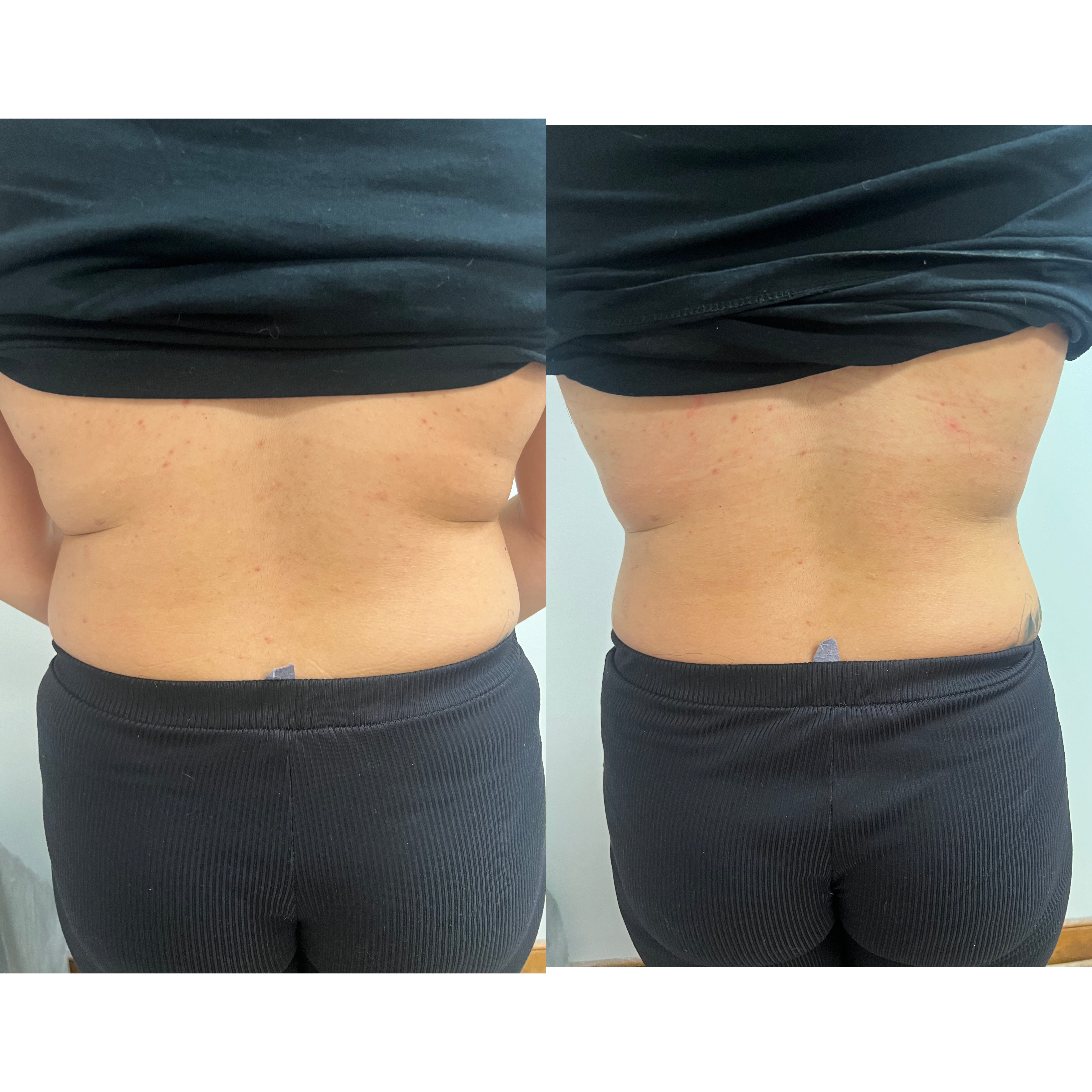 1 Hour Fat Reduction Combo