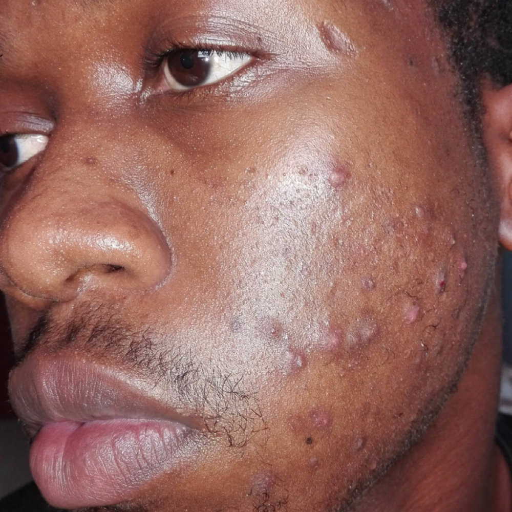 Acne Treatments at The SKN Whisperer in Atlanta, GA