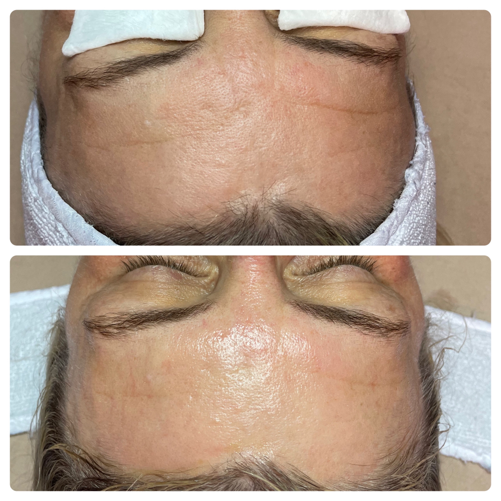 Firming Peptide With Dermaplaning