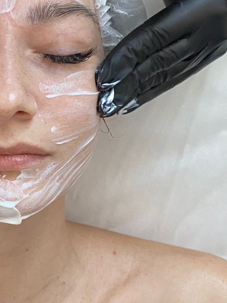 Microdermabrasion Treatment