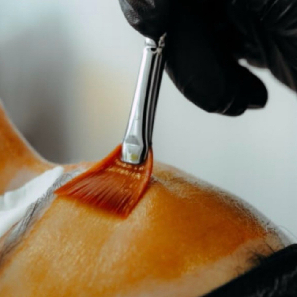 Wrinkle Lift Peel- Level 2 Peel at Esther Esthetics in Suwanee, GA